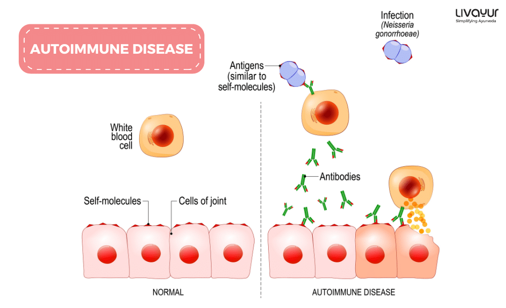 Autoimmune Disease Causes Symptoms Types Treatment More