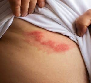 shingles - livayur