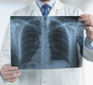 cystic fibrosis