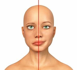 bell's palsy treatment