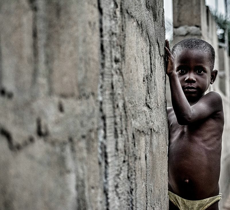 kwashiorkor and marasmus - livayur