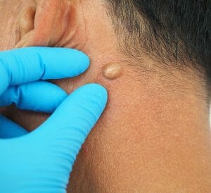 lipoma meaning - livayur
