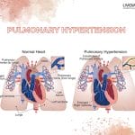PULMONARY HYPEERTENSION