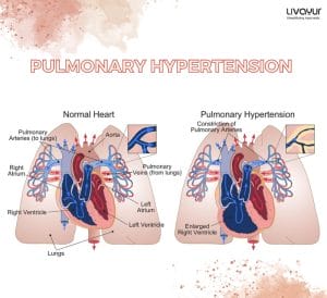 PULMONARY HYPEERTENSION