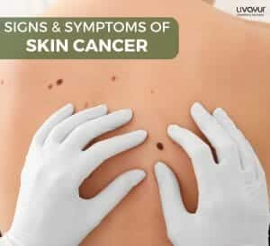 Skin Cancer 1