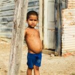 kwashiorkor - livayur