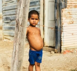 kwashiorkor - livayur