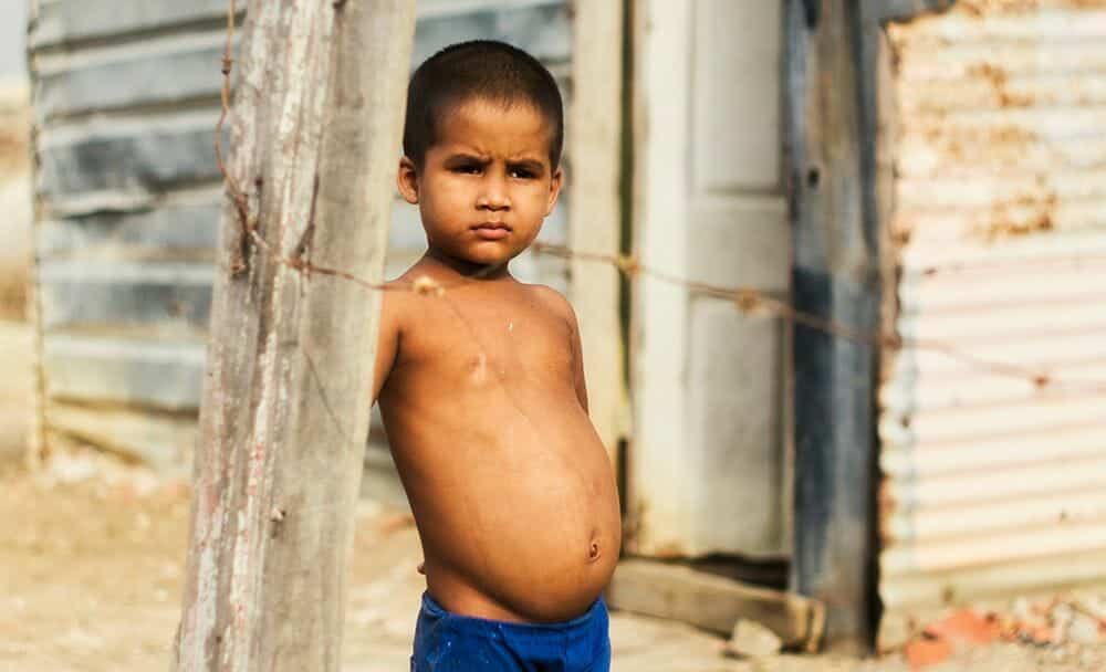 kwashiorkor - livayur