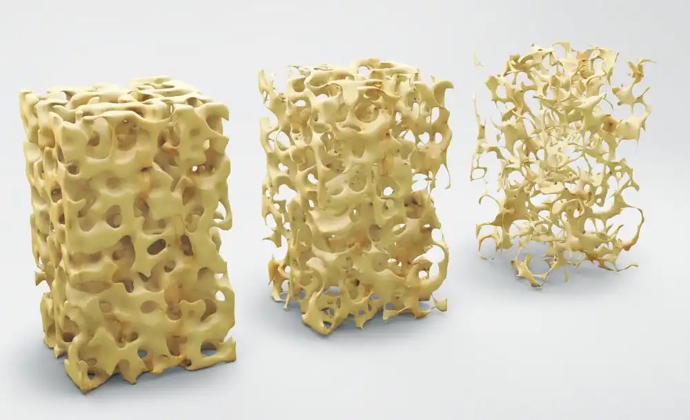 Osteoporosis treatment