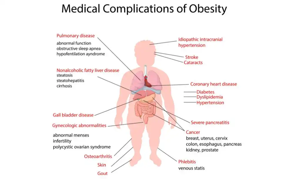 obesity treatment