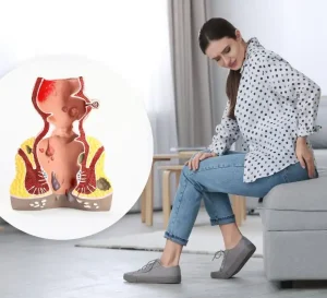 female hemorrhoids