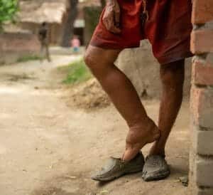 elephantiasis