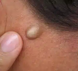 lipoma causes