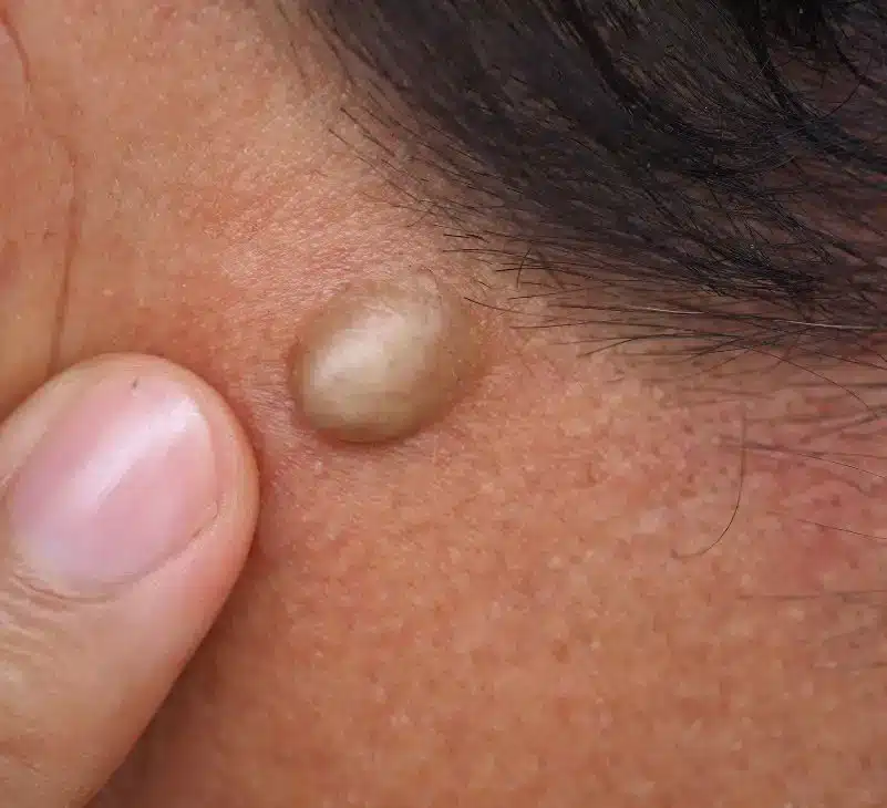lipoma causes