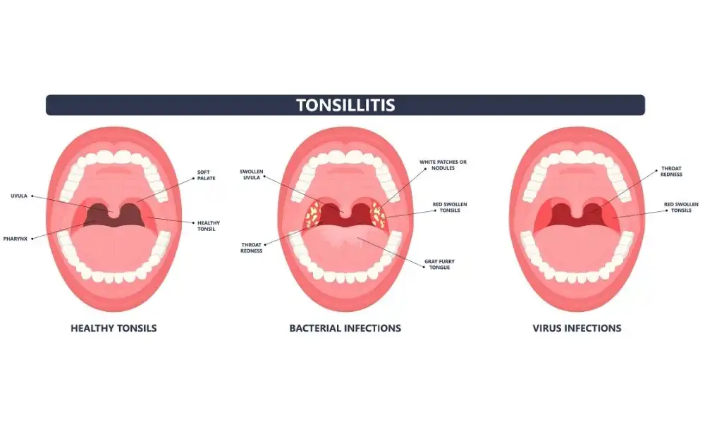 bacteria vs viral infection