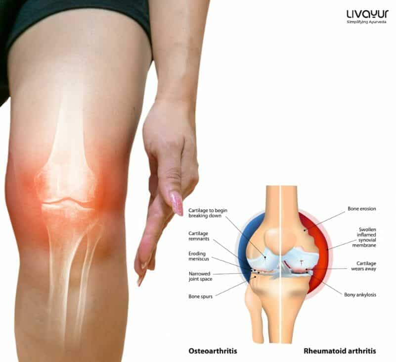 Ayurvedic Medicines Treatments and Remedies for Joint Pain 2