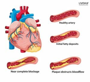 Can Ayurveda Help in Curing Coronary Heart Disease