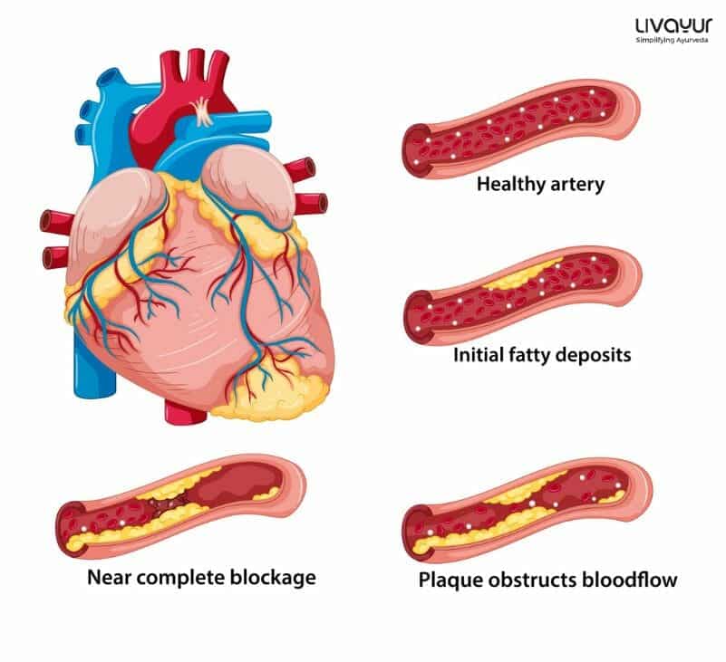 Can Ayurveda Help in Curing Coronary Heart Disease