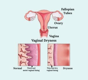 herbs for vaginal dryness
