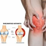Rheumatoid Arthritis 2