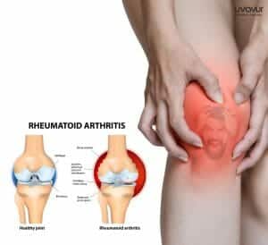 Rheumatoid Arthritis 2