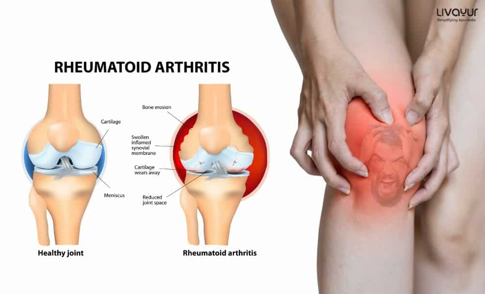 Rheumatoid Arthritis