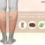 ayurvedic treatment for varicose veins