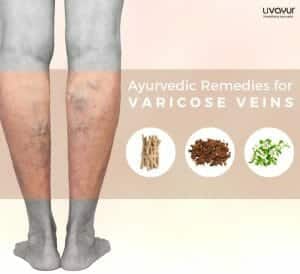 ayurvedic treatment for varicose veins