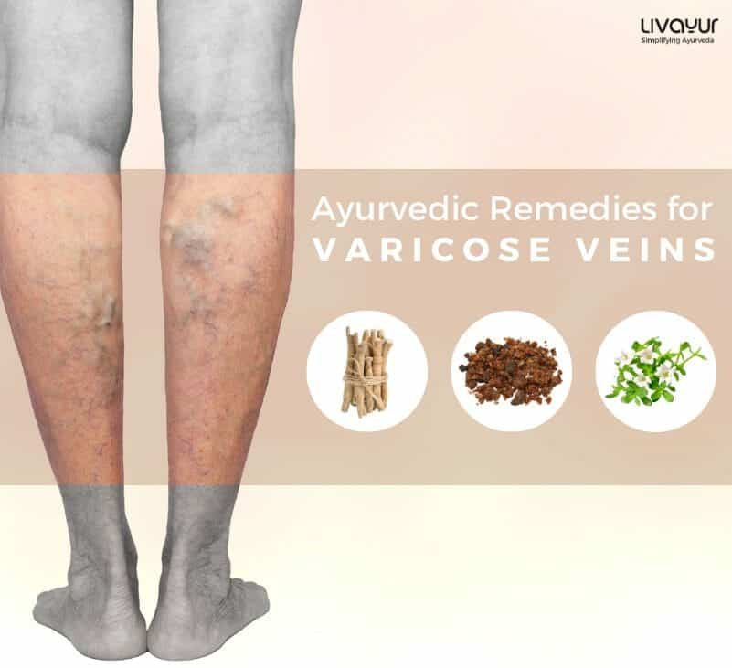 ayurvedic treatment for varicose veins
