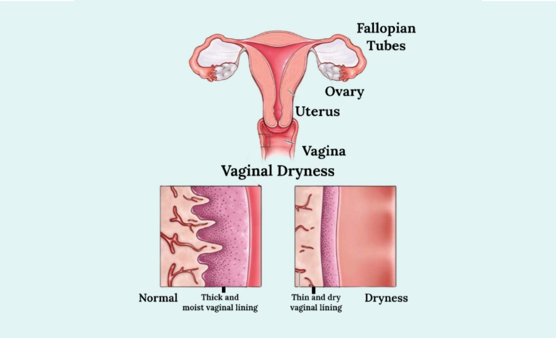 herbs for vaginal dryness