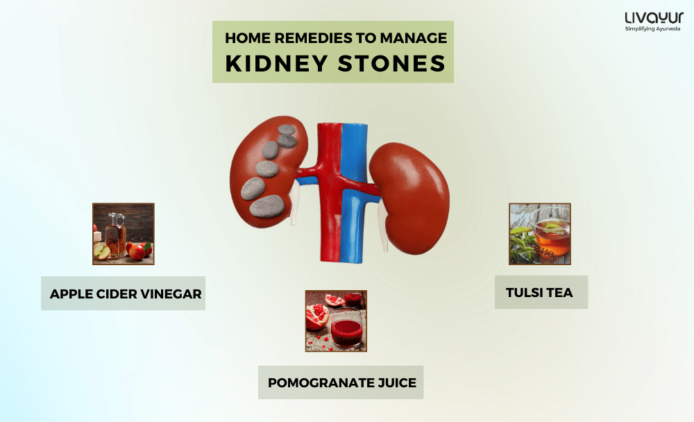 home remedies for kidney stones