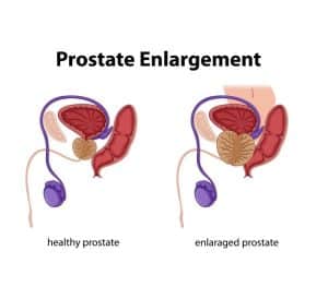 what is prostatomegaly - livayur