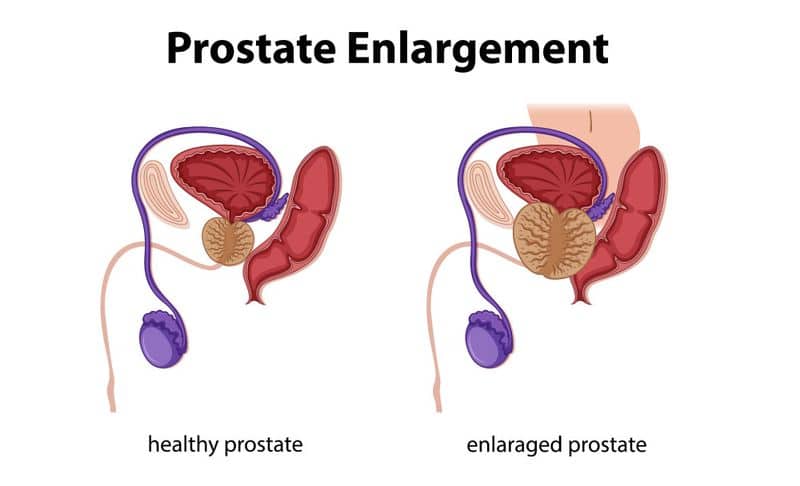 what is prostatomegaly