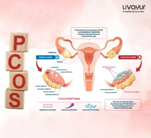 what size of ovarian cyst is dangerous