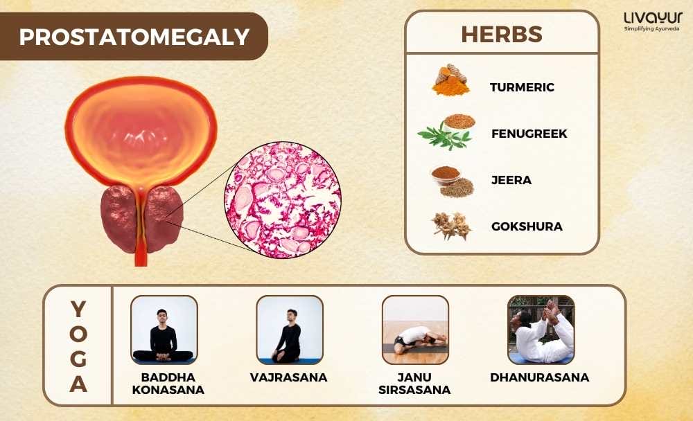 Stages of Prostatomegaly 1