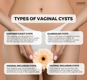 vaginal cyst - livayur