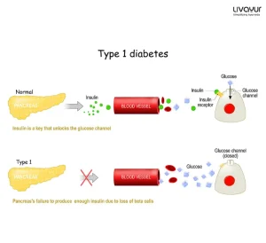 Type 1 Diabetes 1
