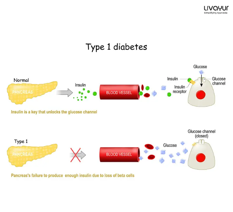 Type 1 Diabetes 1